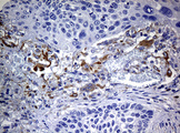 Tyrosinase Antibody - IHC of paraffin-embedded Carcinoma of Human lung tissue using anti-TYR mouse monoclonal antibody.