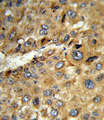 Tyrosine Aminotransferase Antibody - Formalin-fixed and paraffin-embedded human hepatocarcinoma reacted with TAT Antibody , which was peroxidase-conjugated to the secondary antibody, followed by DAB staining. This data demonstrates the use of this antibody for immunohistochemistry; clinical relevance has not been evaluated.