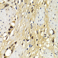 UAP1 Antibody - Immunohistochemistry of paraffin-embedded human stomach cancer tissue.