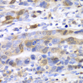 UBCH10 / UBE2C Antibody - Immunohistochemistry of paraffin-embedded human gastric cancer tissue.