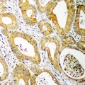 UBCH10 / UBE2C Antibody - Immunohistochemical analysis of UBE2C staining in human colon cancer formalin fixed paraffin embedded tissue section. The section was pre-treated using heat mediated antigen retrieval with sodium citrate buffer (pH 6.0). The section was then incubated with the antibody at room temperature and detected using an HRP conjugated compact polymer system. DAB was used as the chromogen. The section was then counterstained with hematoxylin and mounted with DPX.