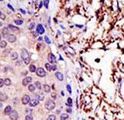 UBE2L3 / UBCH7 Antibody - Formalin-fixed and paraffin-embedded human cancer tissue reacted with the primary antibody, which was peroxidase-conjugated to the secondary antibody, followed by AEC staining. This data demonstrates the use of this antibody for immunohistochemistry; clinical relevance has not been evaluated. BC = breast carcinoma; HC = hepatocarcinoma.