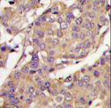 UBE2L6 Antibody - Formalin-fixed and paraffin-embedded breast carcinoma tissue reacted with UBE2L6 Antibody , which was peroxidase-conjugated to the secondary antibody, followed by DAB staining. This data demonstrates the use of this antibody for immunohistochemistry; clinical relevance has not been evaluated.