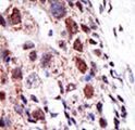 UBE2S / E2 EPF Antibody - Formalin-fixed and paraffin-embedded human cancer tissue reacted with the primary antibody, which was peroxidase-conjugated to the secondary antibody, followed by AEC staining. This data demonstrates the use of this antibody for immunohistochemistry; clinical relevance has not been evaluated. BC = breast carcinoma; HC = hepatocarcinoma.