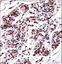 UBP1 Antibody - UBP1 Antibody immunohistochemistry of formalin-fixed and paraffin-embedded human breast tissue followed by peroxidase-conjugated secondary antibody and DAB staining.