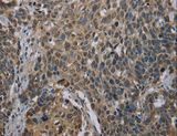 UBP1 Antibody - Immunohistochemistry of paraffin-embedded Human cervical cancer using UBP1 Polyclonal Antibody at dilution of 1:40.