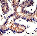 UBQLN3 Antibody - Formalin-fixed and paraffin-embedded human cancer tissue reacted with the primary antibody, which was peroxidase-conjugated to the secondary antibody, followed by DAB staining. This data demonstrates the use of this antibody for immunohistochemistry; clinical relevance has not been evaluated. BC = breast carcinoma; HC = hepatocarcinoma.