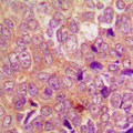 UBR1 Antibody - Immunohistochemical analysis of UBR1 staining in human breast cancer formalin fixed paraffin embedded tissue section. The section was pre-treated using heat mediated antigen retrieval with sodium citrate buffer (pH 6.0). The section was then incubated with the antibody at room temperature and detected using an HRP conjugated compact polymer system. DAB was used as the chromogen. The section was then counterstained with hematoxylin and mounted with DPX.