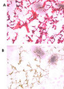 UCHL5 / UCH37 Antibody - HE staining of frozen human ovarian cancer tissue reacted with the primary antibody at a 1:250 dilution. Levels using the antibody on frozen tissue array (A )correlated well with the mRNA expression levels detected by Agilent expression microarray (B). This data demonstrates the use of this antibody for immunohistochemistry; clinical relevance has not been evaluated. 60X magnification. Data courtesy of Marlena Fejzo, University of California, Los Angeles.