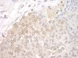 UCKL1 Antibody - Detection of Human UCKL1 by Immunohistochemistry. Sample: FFPE section of human prostate carcinoma. Antibody: Affinity purified rabbit anti-UCKL1 used at a dilution of 1:1000 (1 ug/mg).