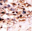 UCKL1 Antibody - Formalin-fixed and paraffin-embedded human cancer tissue reacted with the primary antibody, which was peroxidase-conjugated to the secondary antibody, followed by DAB staining. This data demonstrates the use of this antibody for immunohistochemistry; clinical relevance has not been evaluated. BC = breast carcinoma; HC = hepatocarcinoma.