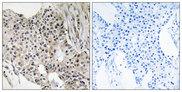 UEVLD Antibody - Immunohistochemistry analysis of paraffin-embedded human breast carcinoma tissue, using UEVLD Antibody. The picture on the right is blocked with the synthesized peptide.