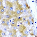UGT1A9 Antibody - Immunohistochemical analysis of GNT1 staining in human liver cancer formalin fixed paraffin embedded tissue section. The section was pre-treated using heat mediated antigen retrieval with sodium citrate buffer (pH 6.0). The section was then incubated with the antibody at room temperature and detected using an HRP conjugated compact polymer system. DAB was used as the chromogen. The section was then counterstained with hematoxylin and mounted with DPX.
