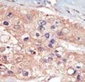 UHMK1 / KIS Antibody - Formalin-fixed and paraffin-embedded human cancer tissue reacted with the primary antibody, which was peroxidase-conjugated to the secondary antibody, followed by DAB staining. This data demonstrates the use of this antibody for immunohistochemistry; clinical relevance has not been evaluated. BC = breast carcinoma; HC = hepatocarcinoma.