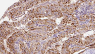 ULK1 Antibody - 1:100 staining human thyroid carcinoma tissue by IHC-P. The sample was formaldehyde fixed and a heat mediated antigen retrieval step in citrate buffer was performed. The sample was then blocked and incubated with the antibody for 1.5 hours at 22°C. An HRP conjugated goat anti-rabbit antibody was used as the secondary.