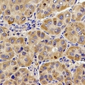 UQCR10 / UCRC Antibody - Immunohistochemical analysis of UQCR10 staining in human liver cancer formalin fixed paraffin embedded tissue section. The section was pre-treated using heat mediated antigen retrieval with sodium citrate buffer (pH 6.0). The section was then incubated with the antibody at room temperature and detected using an HRP conjugated compact polymer system. DAB was used as the chromogen. The section was then counterstained with hematoxylin and mounted with DPX.