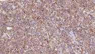 URAT1 / SLC22A12 Antibody - 1:100 staining human lymph carcinoma tissue by IHC-P. The sample was formaldehyde fixed and a heat mediated antigen retrieval step in citrate buffer was performed. The sample was then blocked and incubated with the antibody for 1.5 hours at 22°C. An HRP conjugated goat anti-rabbit antibody was used as the secondary.