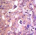 USP1 Antibody - Formalin-fixed and paraffin-embedded human cancer tissue reacted with the primary antibody, which was peroxidase-conjugated to the secondary antibody, followed by AEC staining. This data demonstrates the use of this antibody for immunohistochemistry; clinical relevance has not been evaluated. BC = breast carcinoma; HC = hepatocarcinoma.