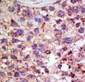 USP11 Antibody - Formalin-fixed and paraffin-embedded human cancer tissue reacted with the primary antibody, which was peroxidase-conjugated to the secondary antibody, followed by AEC staining. This data demonstrates the use of this antibody for immunohistochemistry; clinical relevance has not been evaluated. BC = breast carcinoma; HC = hepatocarcinoma.