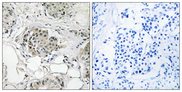USP13 Antibody - Immunohistochemistry analysis of paraffin-embedded human breast carcinoma tissue, using USP13 Antibody. The picture on the right is blocked with the synthesized peptide.