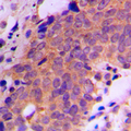 USP19 Antibody - Immunohistochemical analysis of USP19 staining in human breast cancer formalin fixed paraffin embedded tissue section. The section was pre-treated using heat mediated antigen retrieval with sodium citrate buffer (pH 6.0). The section was then incubated with the antibody at room temperature and detected using an HRP conjugated compact polymer system. DAB was used as the chromogen. The section was then counterstained with hematoxylin and mounted with DPX.