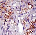 USP22 Antibody - Formalin-fixed and paraffin-embedded human cancer tissue reacted with the primary antibody, which was peroxidase-conjugated to the secondary antibody, followed by DAB staining. This data demonstrates the use of this antibody for immunohistochemistry; clinical relevance has not been evaluated. BC = breast carcinoma; HC = hepatocarcinoma.