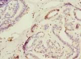 USP30 Antibody - Immunohistochemistry of paraffin-embedded human breast cancer using antibody at dilution of 1:100.