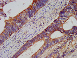 USP37 Antibody - Immunohistochemistry image at a dilution of 1:200 and staining in paraffin-embedded human colon cancer performed on a Leica BondTM system. After dewaxing and hydration, antigen retrieval was mediated by high pressure in a citrate buffer (pH 6.0) . Section was blocked with 10% normal goat serum 30min at RT. Then primary antibody (1% BSA) was incubated at 4 °C overnight. The primary is detected by a biotinylated secondary antibody and visualized using an HRP conjugated SP system.