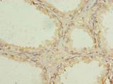 USP47 Antibody - Immunohistochemistry of paraffin-embedded human prostate cancer using antibody at dilution of 1:100.