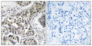 USP6NL Antibody - Immunohistochemistry analysis of paraffin-embedded human breast carcinoma, using USP6NL Antibody. The picture on the right is blocked with the synthesized peptide.