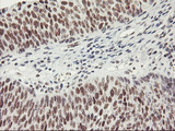 USP7 / HAUSP Antibody - IHC of paraffin-embedded Carcinoma of Human bladder tissue using anti-USP7 mouse monoclonal antibody.