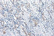 UTS2 / Urotensin II Antibody - Immunohistochemistry of paraffin-embedded Human stomach cancer using UTS2 Polyclonal Antibody at dilution of 1:100.