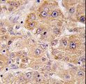 UVRAG Antibody - Formalin-fixed and paraffin-embedded human hepatocarcinoma tissue reacted with hUVRAG , which was peroxidase-conjugated to the secondary antibody, followed by DAB staining. This data demonstrates the use of this antibody for immunohistochemistry; clinical relevance has not been evaluated.