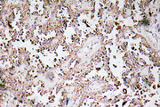 VAMP1+2+3 Antibody - IHC of VAMP-1/2/3 (D70) pAb in paraffin-embedded human lung carcinoma tissue.