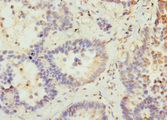 VANGL2 / LTAP Antibody - Immunohistochemistry of paraffin-embedded human lung cancer at dilution 1:100