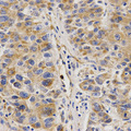 VAPB Antibody - Immunohistochemistry of paraffin-embedded human liver cancer tissue.