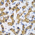 VAPB Antibody - Immunohistochemical analysis of VAP-B/C staining in human liver cancer formalin fixed paraffin embedded tissue section. The section was pre-treated using heat mediated antigen retrieval with sodium citrate buffer (pH 6.0). The section was then incubated with the antibody at room temperature and detected using an HRP conjugated compact polymer system. DAB was used as the chromogen. The section was then counterstained with hematoxylin and mounted with DPX.