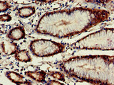 VASH2 Antibody - Immunohistochemistry of paraffin-embedded human gastric cancer at dilution of 1:100