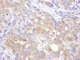 VCPIP1 Antibody - Detection of Human VCIP135 by Immunohistochemistry. Sample: FFPE section of human ovarian carcinoma. Antibody: Affinity purified rabbit anti-VCIP135 used at a dilution of 1:200 (1 ug/ml). Detection: DAB.