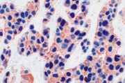 Tumor (double label): p53 (m), VECTASTAIN® ABC-AP Kit, Vector Blue™ substrate (blue); Multi-Cytokeratin (m), VECTASTAIN® Elite® ABC Kit, AEC substrate (red).