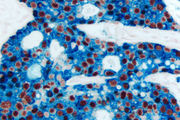 Breast Carcinoma (double label): Estrogen Receptor (m), ImmPRESS™ Universal Reagent, Vector® NovaRED® substrate (red); Cytokeratin 8/18 (m), VECTASTAIN® Universal ABC-AP Kit, Vector Blue™ substrate (blue).