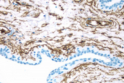 Breast Cancer: CD34 antigen stained using VECTASTAIN® Elite® ABC Kit and Vector® DAB (brown) substrate. Hematoxylin QS (blue) counterstain.