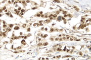Breast Cancer: p53 protein stained using VECTASTAIN® Elite® ABC Kit and Vector® DAB (brown) substrate. Hematoxylin QS (blue) counterstain.