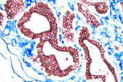 Breast Cancer (double Label): Epithelium (red, Vector® NovaRED), endothelium (blue, Vector® Blue).