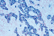 Tumor tissue section showing specific cytoplasmic cell staining (blue/gray, Vector® SG) with Vector® Nuclear Fast Red (red) counterstain.