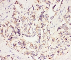VEGF Antibody - IHC-P: VEGF antibody testing of human lung cancer tissue