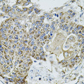 VEPH1 Antibody - Immunohistochemistry of paraffin-embedded human lung cancer tissue.