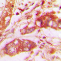 VGF Antibody - Immunohistochemical analysis of VGF staining in human lung cancer formalin fixed paraffin embedded tissue section. The section was pre-treated using heat mediated antigen retrieval with sodium citrate buffer (pH 6.0). The section was then incubated with the antibody at room temperature and detected using an HRP conjugated compact polymer system. DAB was used as the chromogen. The section was then counterstained with hematoxylin and mounted with DPX.