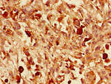 VGF Antibody - Immunohistochemistry of paraffin-embedded human melanoma cancer using VGF Antibody at dilution of 1:100