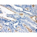 VIL1 / Villin Antibody - Villin antibody IHC-paraffin. IHC(P): Human Intestinal Cancer Tissue.